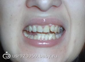 до ношения брекетов неправильный прикус